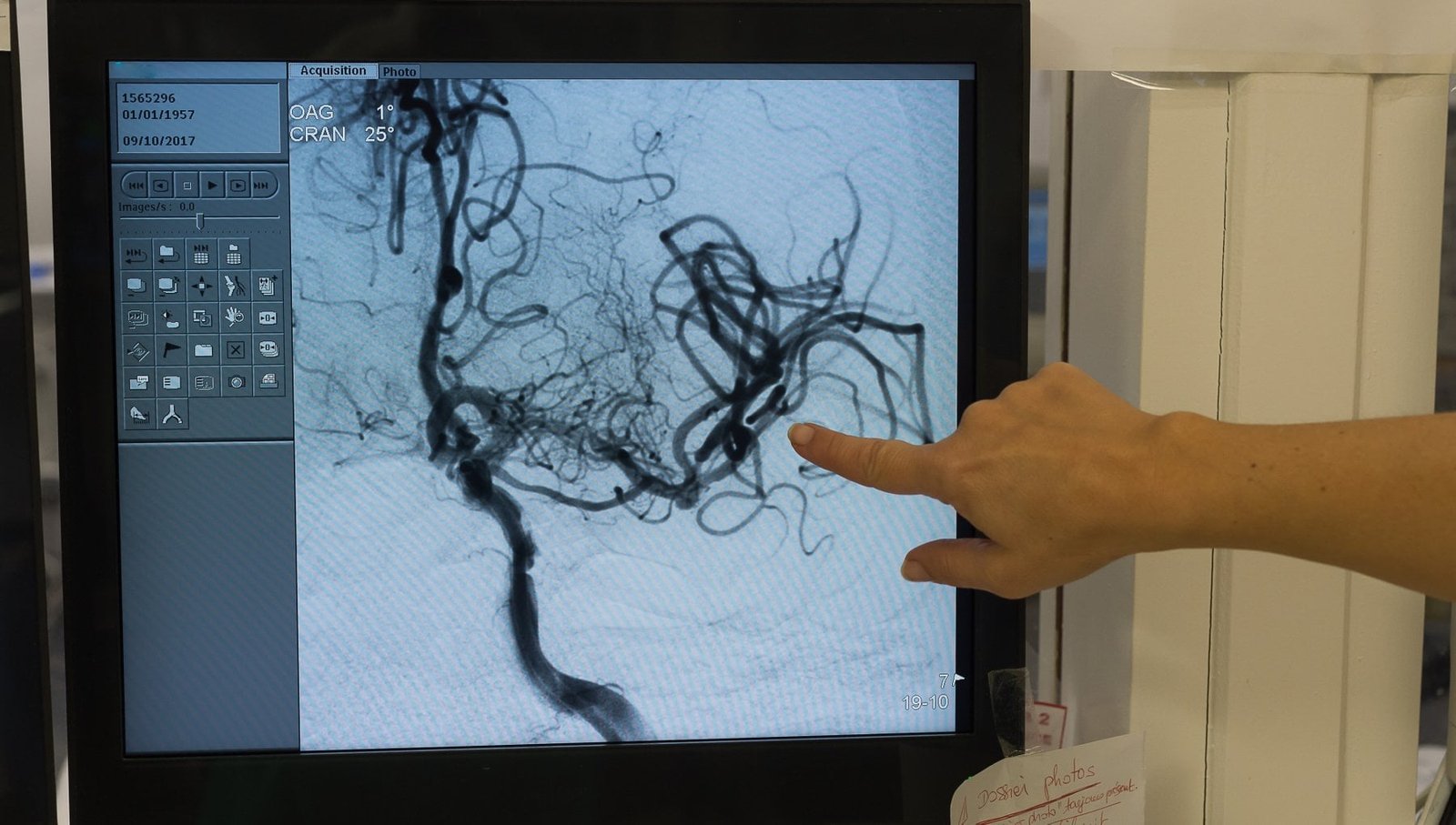 L'Asp di Messina e Comune, con l'Uosd Stroke del Policlinico promuovono per il 29 ottobre la giornata Mondiale Ictus 6 stroke